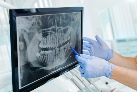 Dental X Rays